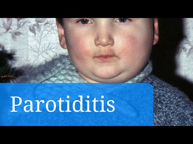 Parotiditis causas y prevencion