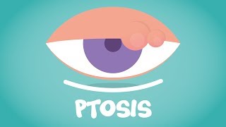 What is Ptosis?