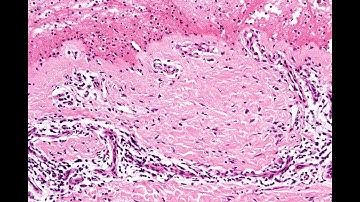 An introduction to the diagnosis of subepidermal blisters Phillip McKee