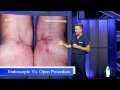Carpal Tunnel Release - Open Procedure vs. Endoscopic
