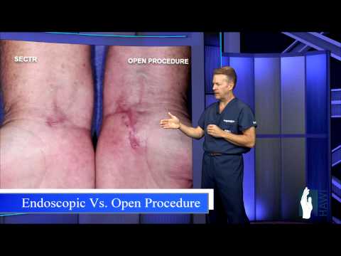 Carpal Tunnel Release - Open Procedure vs. Endoscopic