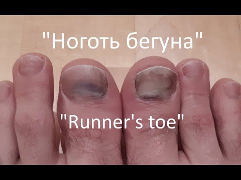 Как избежать "Ноготь бегуна"?