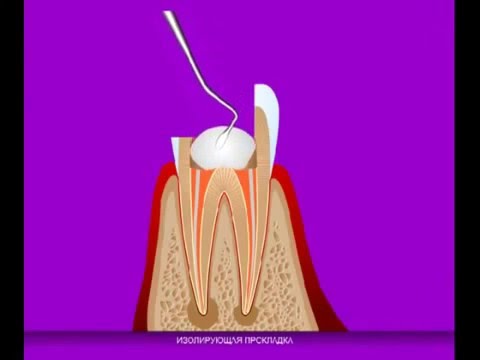 Лечение периодонтита.