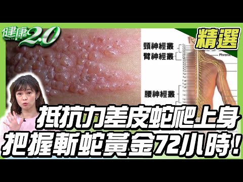 抵抗力差「皮蛇」爬上身！把握斬蛇黃金72小時！【健康2.0精選】