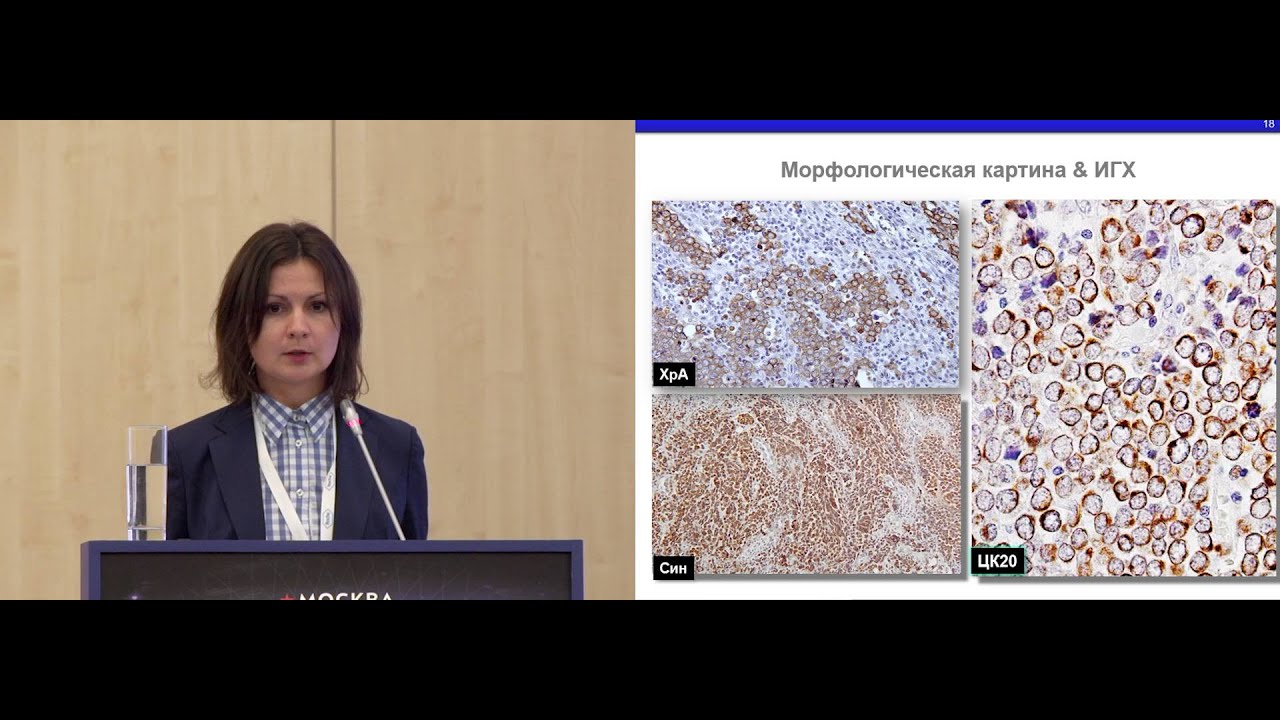 Карцинома Меркеля: современные подходы и перспективы терапии - YouTube