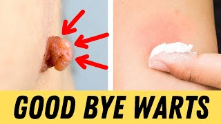 Warts? Say Goodbye with This Simple Home Remedy screenshot 5