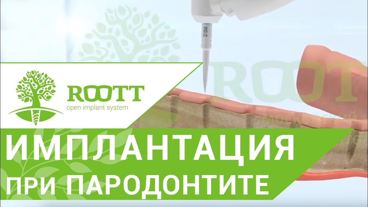 Пародонтит лечение. 👍 Эффективное лечение пародонтита с помощью ...