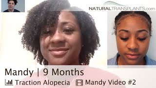 Black Hair Transplant Before and After | Black Hair Transplant Specialist  (Mandy) - YouTube