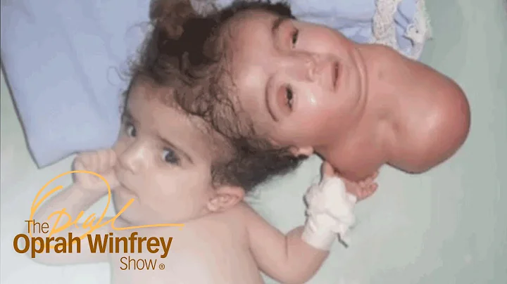 The 2-Headed Baby Miracle | The Oprah Winfrey Show...