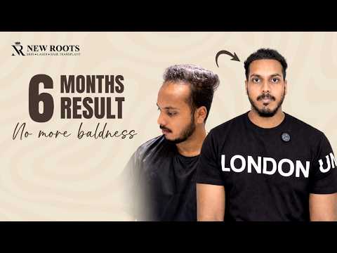 I Got My Hair Back in 6 Months 😍 | Hair Transplant in Nashik | Cost & Best Results