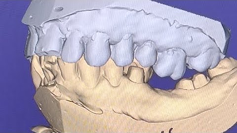 Edit Mesh with exocad very easy