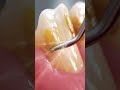 Teeth Cleaning Animation