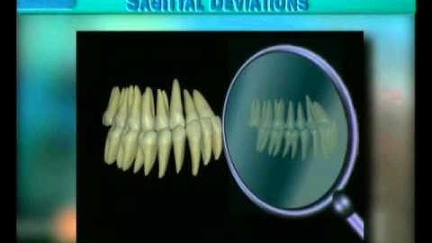Clip 45: Various Stages Between Mild and Severe Class III Malocclusion