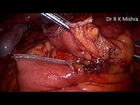 Conversion From Sleeve Gastrectomy To Roux-en-Y Gastric Bypass