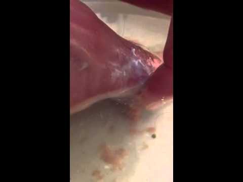 Gross infected blister pop! - YouTube