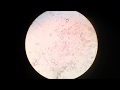 Stool Microscopy Fat Droplets In Stool
