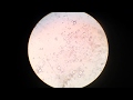 Fat Globules In Stool Test