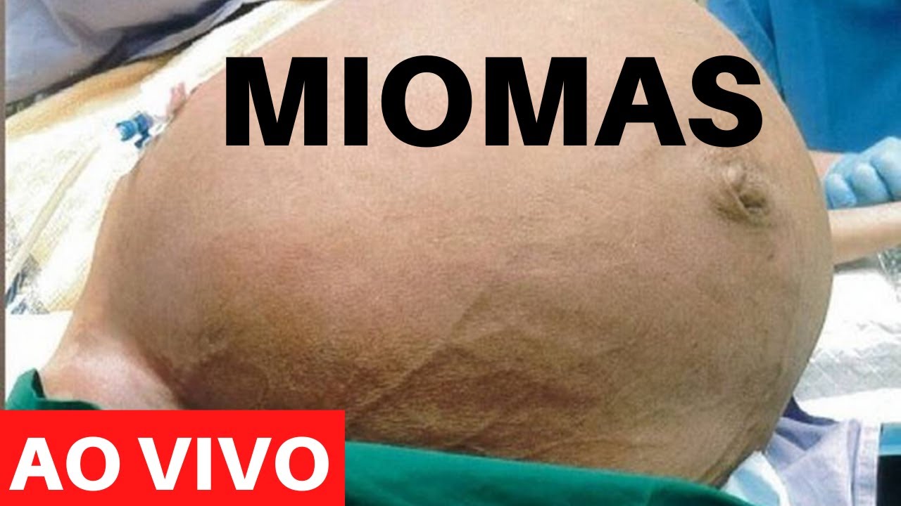 MIOMAS: Quando o mioma é perigoso? - YouTube