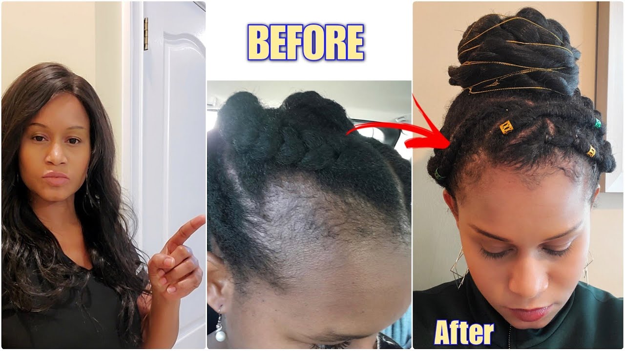 How To Grow Thin Hair To Thick Hair Naturally Stop Hair Fall & Alopecia Diet & Treatment