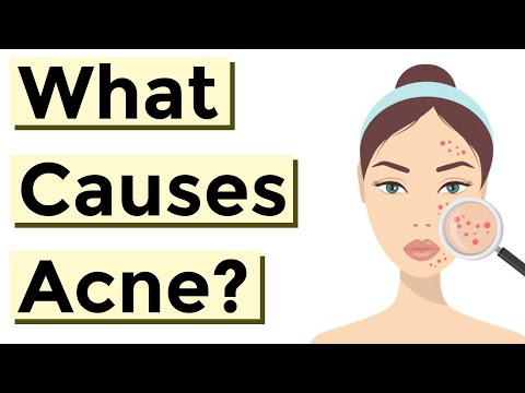 What Causes Acne? A Brief Explanation (Made Simple to Understand)