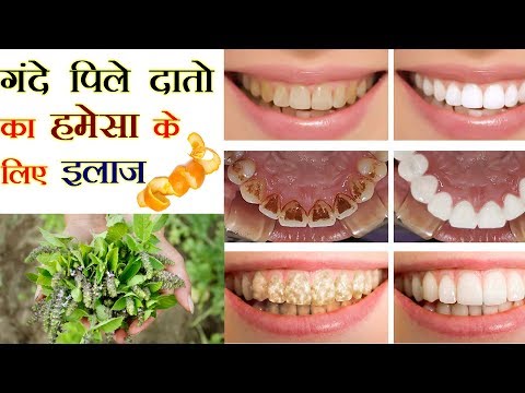गंदे-पीले-दांत-को-तेजी-से-मोती-जैसा-सफेद-बनाएं---चमकदार-बना-देगा-ये-अद्भुत-नुस्खा-/-#teethwhitening