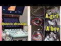 learning, what are difference between baby boy and girl ultrasound #ultrasound