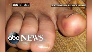 Doctors warn of mystery coronavirus symptom called 'COVID toes'