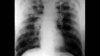 Silicosis