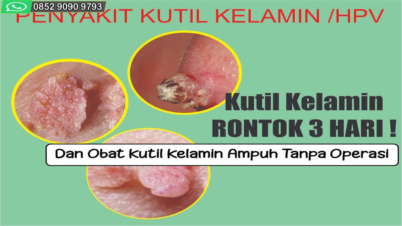 Obat Kutil Kemaluan Alami Dan Obat Kutil Kelamin Ampuh Tanpa Operasi