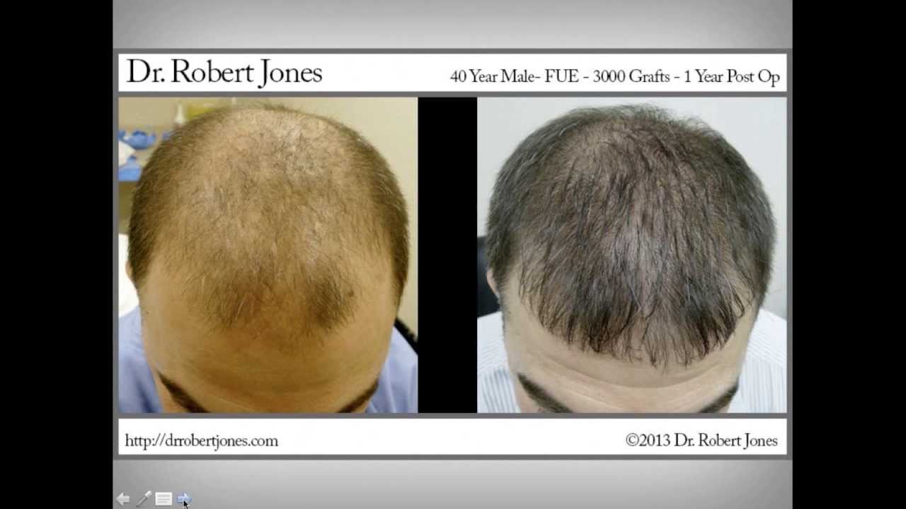 Пересадка волос в санкт петербурге. Голова до и после пересадки волос. Прически после пересадки волос. Процесс заживления после пересадки волос.
