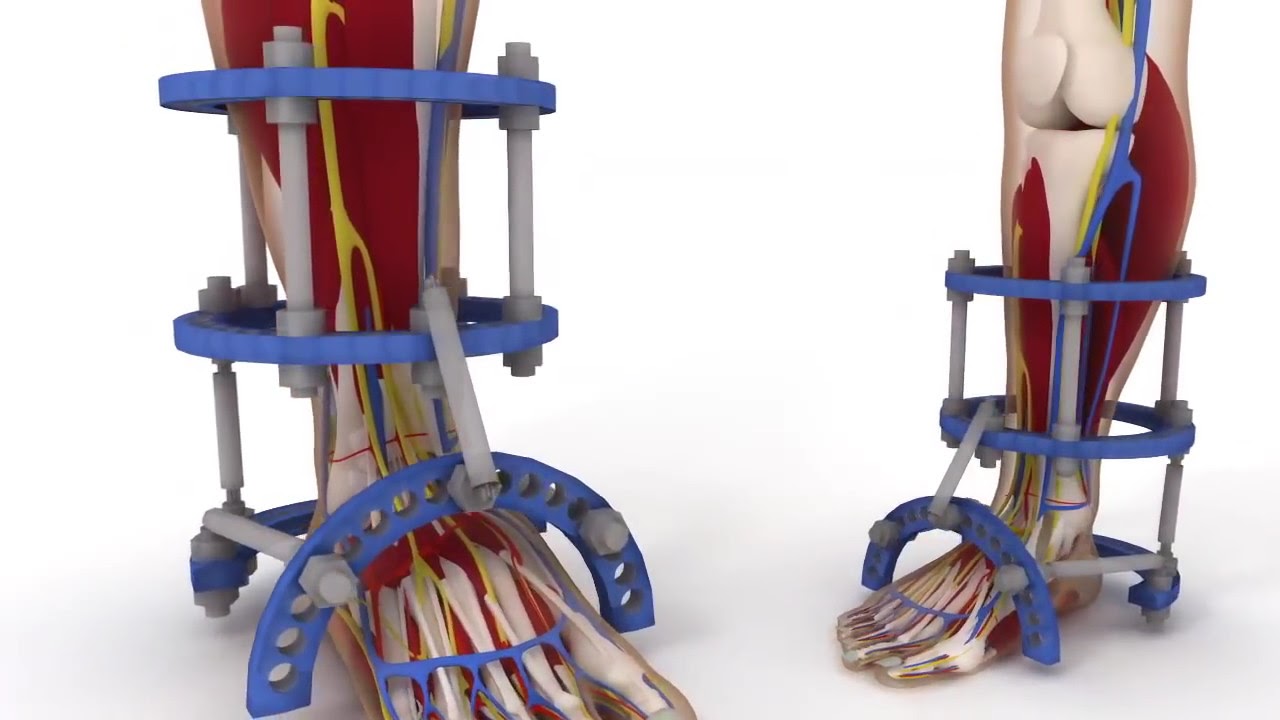 Static Foot Ilizarov Static Dynamic External Frame Foot Leg Apparatus - YouTube