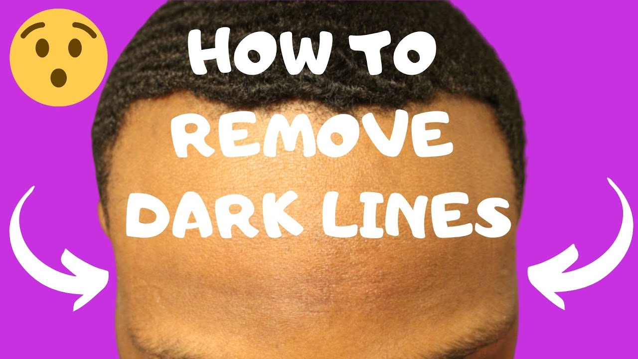 360 Waves | How To Remove Dark Durag Lines + 11 Week Wolf!