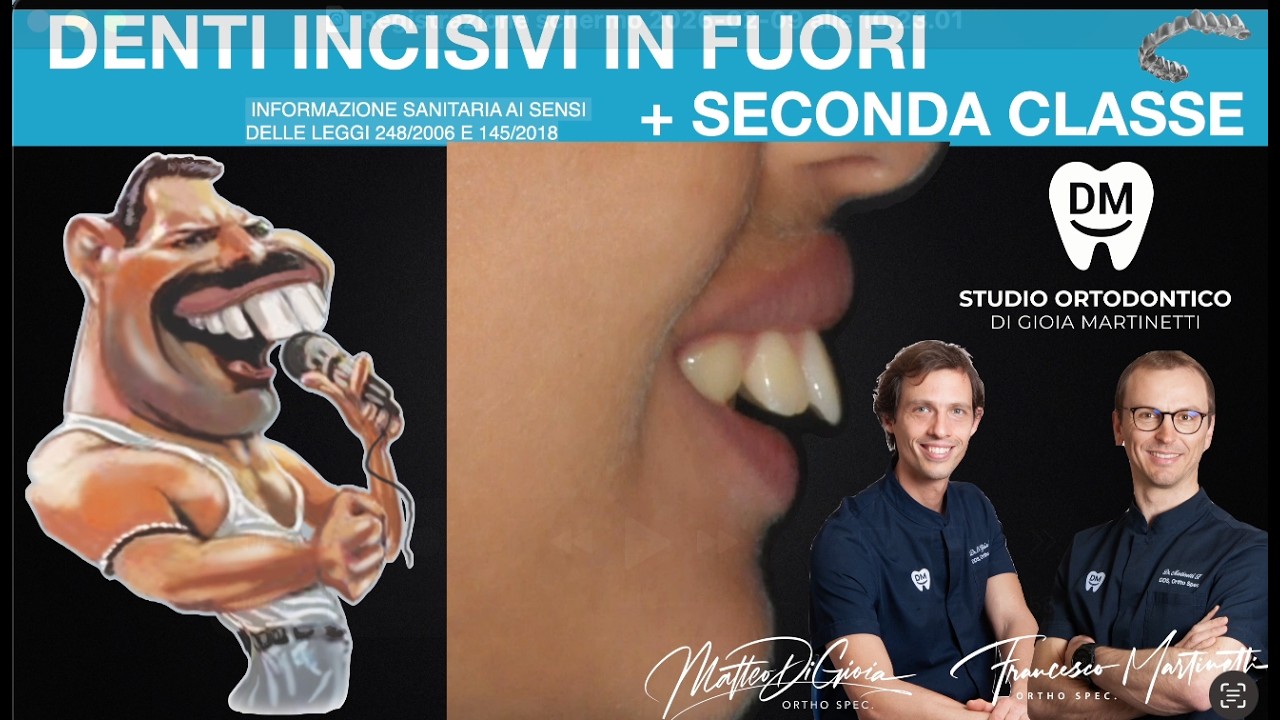 Denti Sporgenti in fuori Adolescente Correzione con Allineatori trasparenti apparecchio denti