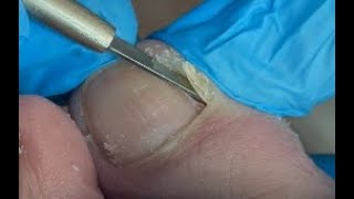 So much deadskin under toenail