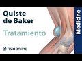 Cómo tratar el quiste de Baker - Guía para pacientes