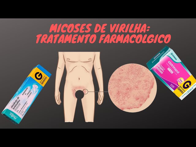 Micose na virilha: causas, sintomas e tratamento