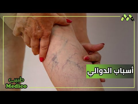 أسباب الدوالي وطرق الوقاية وخطورة الإهمال في علاجها مع أ د سامح الأمام