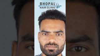 Get The Best Hair Transplant at Bhopal Hair Clinics #besthairtransplantclinic #shorts
