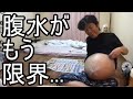 【金バエ】悲報 腹水が限界を超えている事を語る【肝不全 余命1年】 2024/01/12