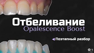 Отбеливание зубов Opalescence Boost. Поэтапный разбор.