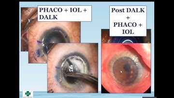 Phẫu thuật ghép Giác Mạc: Bệnh học giác mạc, chỉ định, chống chỉ định và kinh nghiệm lâm sàng