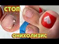 Огромная подногтевая мозоль 😱 СТОП онихолизис! Аппаратный педикюр