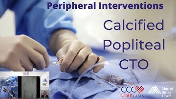Calcified Popliteal CTO