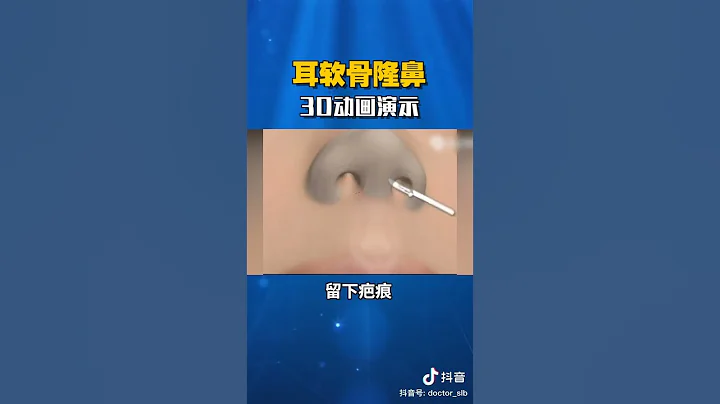耳軟骨隆鼻，3D動畫演示，讓您更了解過程 - 天天要聞