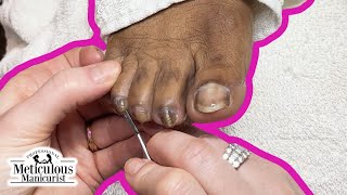 Twisting, Turning, and Curling Toenails Pedicure Tutorial