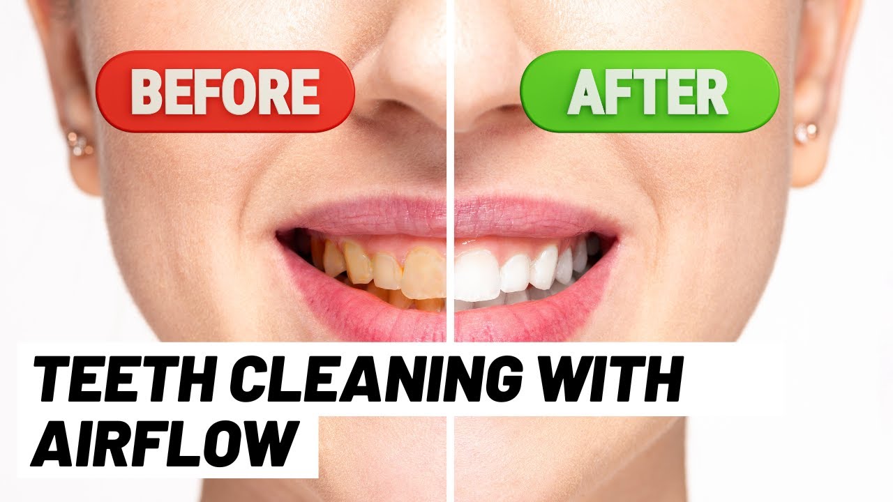 Gentle Teeth Cleaning with Airflow