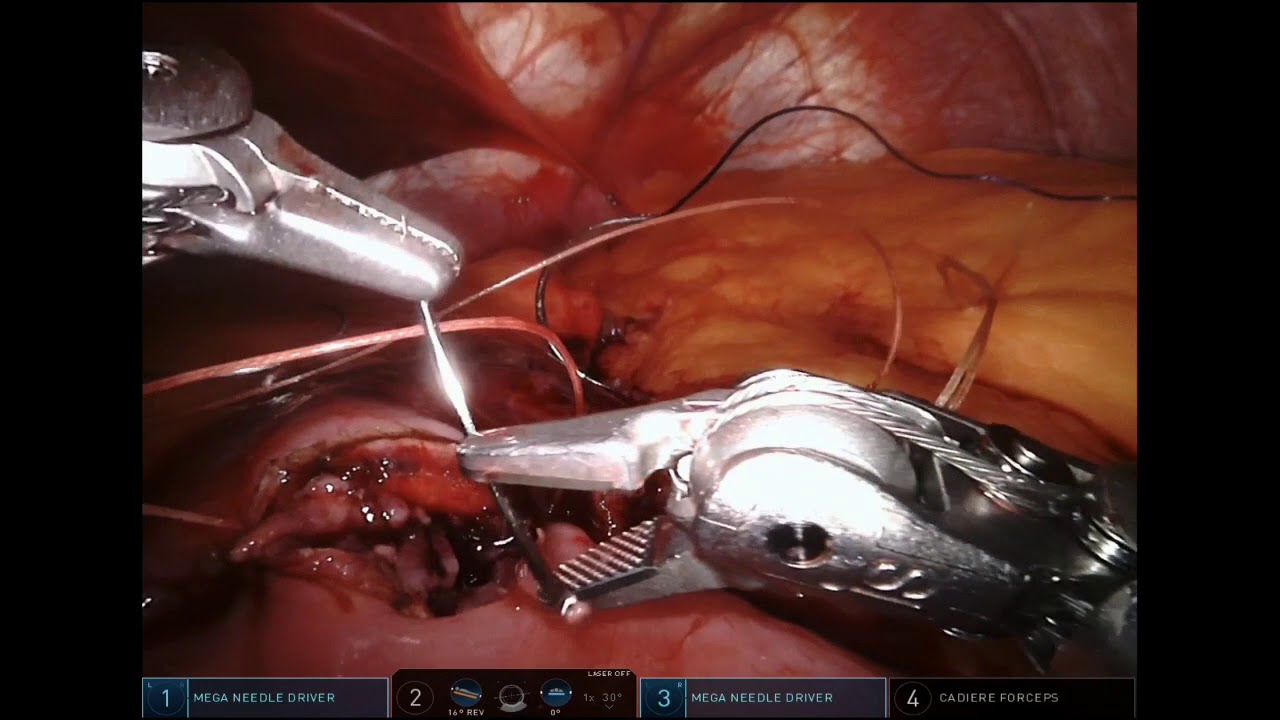 da Vinci Xi fully robotic Roux en-Y Gastric Bypass by Richard DiCicco, MD - YouTube