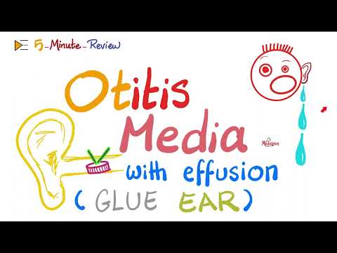 Otitis Media with effusions - Glue Ear