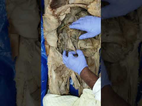 4. Peritoneum & epiploic foramen