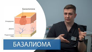 БАЗАЛИОМА | Базальноклеточный рак кожи | Способы лечения